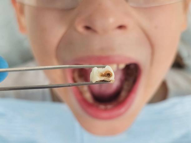Best Emergency Dental Care for Broken or Chipped Teeth in Bull Run Mountain Estates, VA